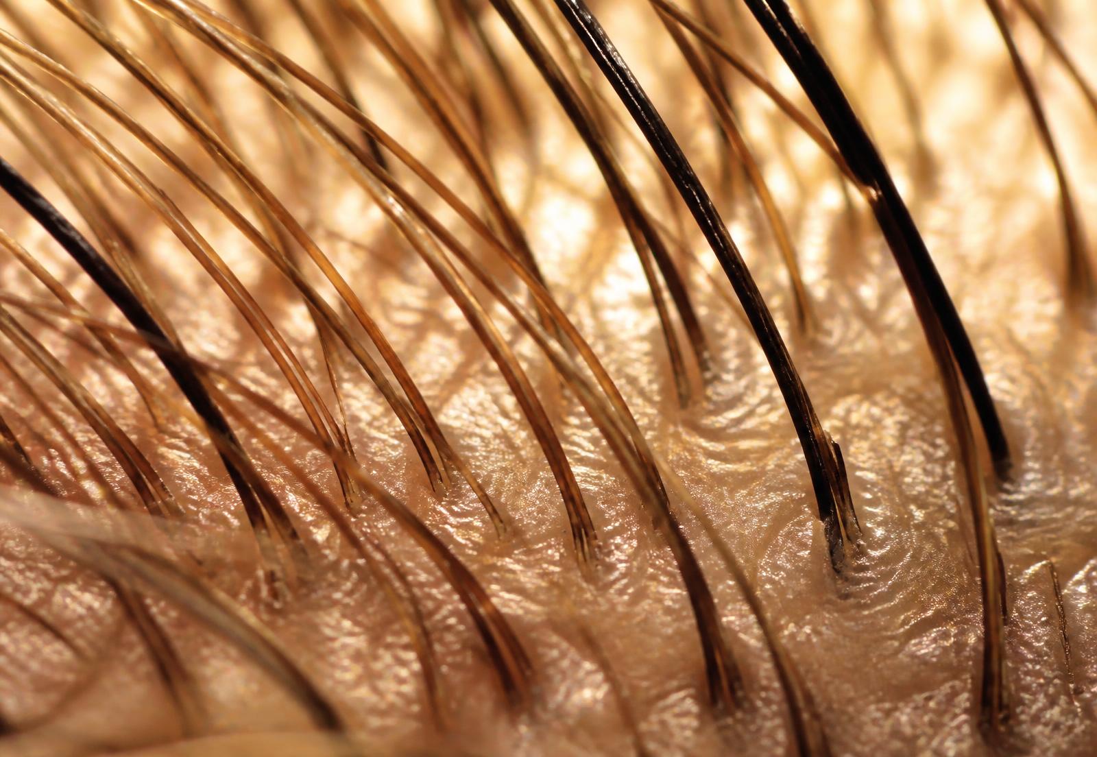 Macro photograph of hair strands emerging from healthy scalp tissue